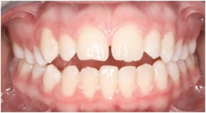 Orthodontists in Sebastopol - Common Problems in Orthodontics