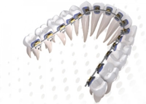 Sebastopol Orthodontics - Ovation-L-Braces