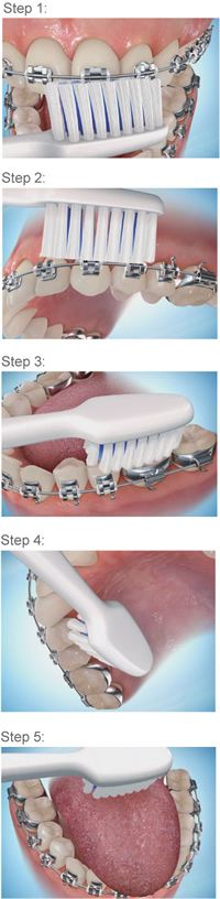 Brushing-steps