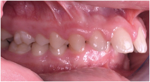 Orthodontists in Sebastopol - Common Problems in Orthodontics