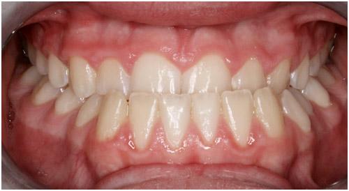 Orthodontists in Sebastopol - Common Problems in Orthodontics